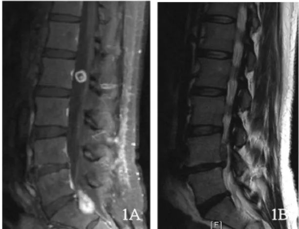 Fig. 2 Intraoperative  photographs  demonstrate  the  schwannomas at L2 (A) and S1 (B).