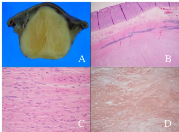 Fig. 1 (A) Initial endoscopic finding. Along the anterior wall of  great  curvature  side  of  mid  body,  large  and  hard  protruded lesion covered with normal-appearing mucosa is  seen.