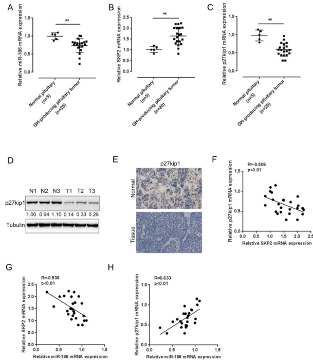 Fig. 4. The expression of and correlations among miR-186, SKP2 and p27 Kip1  in human tissue samples
