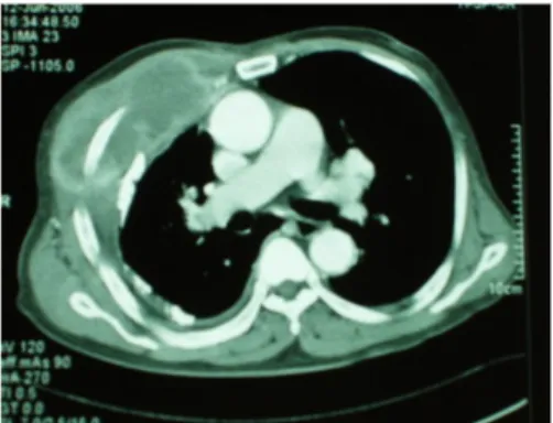 Fig. 4. Pleural biopsy shows diffuse infiltration of atypical  lymphoid  cells  (leukocyte  common  antigen  immunostain, 