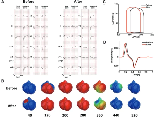 Fig. 3. Simulated effects of cardiac resynchronization therapy (CRT). (A) Standard 12-lead electrocardiogram (ECG) before (left) and after (right)  CRT
