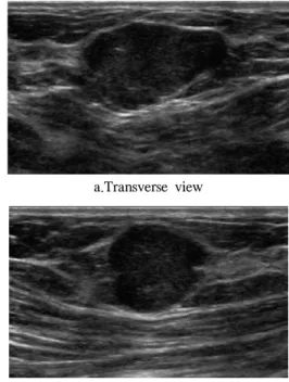 Fig. 1 A 40-year-old woman with a palpable mass. A sonogram shows a circumscribed, oval, parallel hypoechoic mass with focal ill define margin