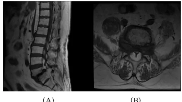 Fig. 1A-B. Magnetic resonance imaging sagittal (A) and axial (B) T1-weighted images demonstrate overgrowth of fat tissue in the spinal canal and compressing the thecal sac and nerve roots
