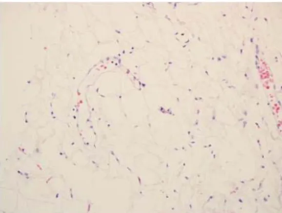 Fig. 2. The microscopic examination shows mature fat cells with thin capillaries, H-E, x200.