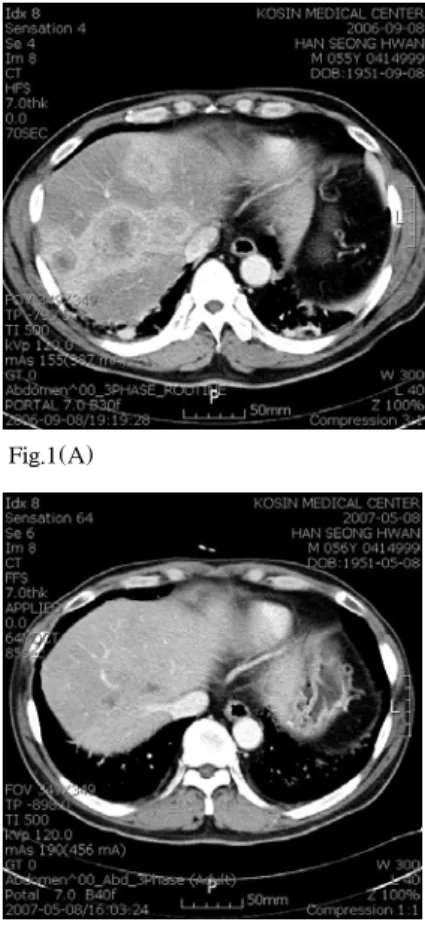 Fig. 2. Chest X-ray findings. Initial chest X-ray shows bilateral interstitial infiltrates and cavitary change in the right upper lobe.