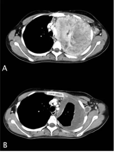 Fig 2. (A) Chest CT reveals huge mass in left lung field and axillary infiltration.