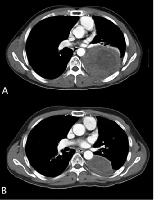 Fig. 4 (A) Chest CT demonstrates non-enhanced heterogeneous mass.