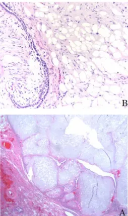 Fig. 1. Preoperative chest PA shows well-defined nodular opacity in right lower lobe.(A) Chest CT reveals about 1.1×1cm sized and well defined nodule in anterobasal segment of RLL abutting to minor fissure.