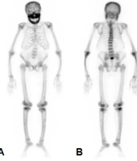 Fig. 2. Plain radiograph shows salt and pepper appearance (A).