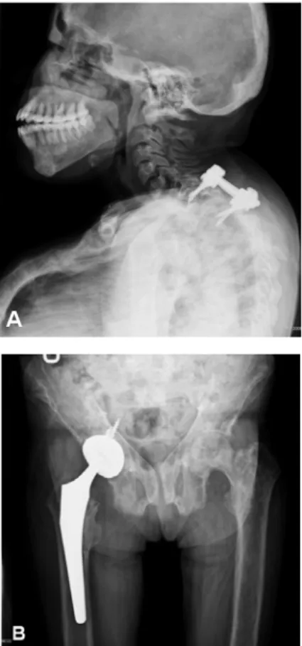 Fig 4. Plain radiographs of after surgery with implants in situ.