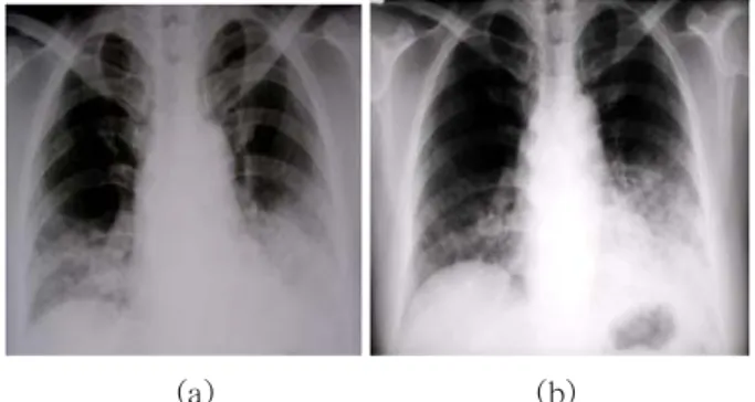 Fig. 5. Radiologic improvement after whole lung lavage. (a) The chest X-ray before whole lung lavage