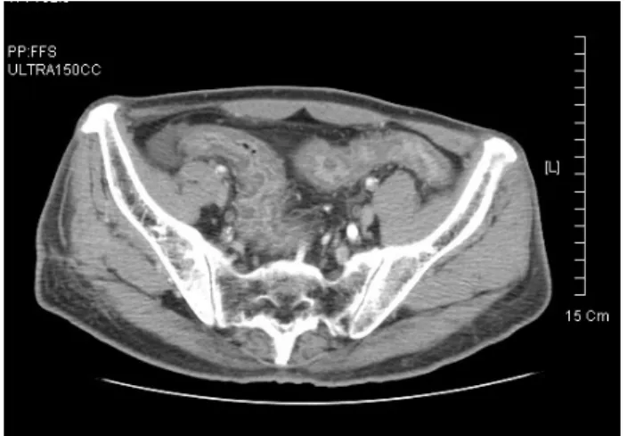 Fig. 2. CT scan of the abdomen. Abdominopelvic CT shows diffuse edematous wall thickening in rectosigmoid colon.(Case 2)