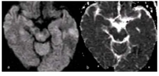 Fig. 1. There is no ischemic lesion of hippocampus in diffusion weighted image(a) and apparent diffusion coefficient(b).