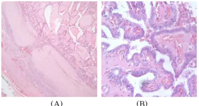 Fig. 1. Pathological appearance of (A)Follicular carcinoma with capsular invasion on Rt