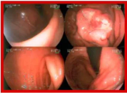 Fig. 1. Endoscopically, Borrmann type II gastric cancer lesion was observed in upper third.