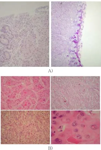 Fig. 3. Typical histologic feature of HCC composed of thin or thick trabecular pattern, which is well demarcated from adjacent normal-appearing liver parenchyme