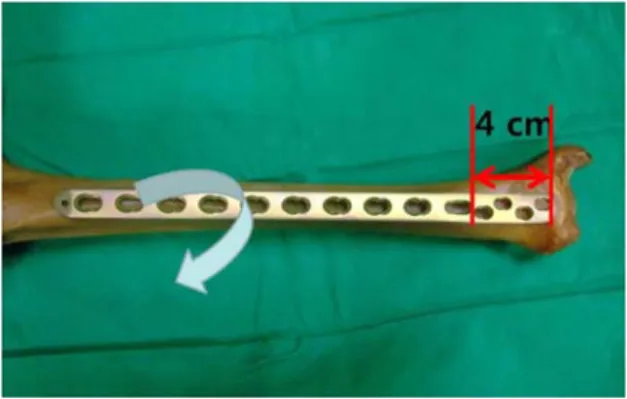 Fig. 1. Closeup photograph of preoperative bending of locking compression plate