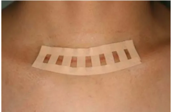 Fig. 2. Photography of group 2 patient. Steri-Strips Ⓡ was applied after absorbable dermal closure on the incisional wound of thyroidectomy.