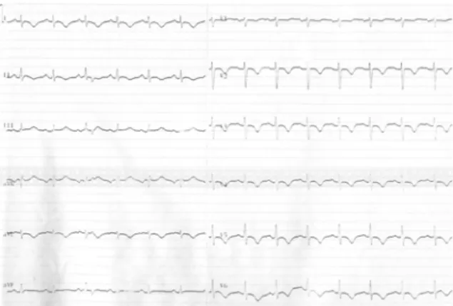 Fig. 4. Echocardiography at onset of SICM. Basal segment was hyperkinetic and mid and apical segment was severely hypokinetic(A