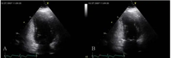 Fig. 7. Follow up echocardiography after 1month. Ejection fraction was 62% and there was no regional wall motion abnormality(A
