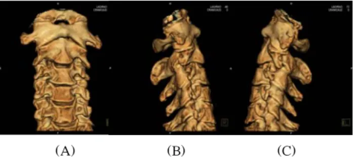 Fig. 3. A, B and C, After closed manual reduction under general anesthesia, CT scan showed good position of the C1–