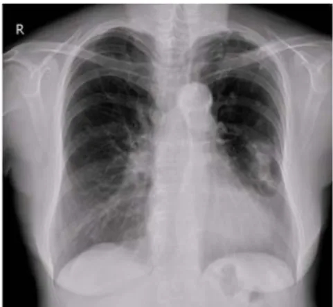 Fig. 1. Chest PA. Increased soft tissue densities in left middle lung field.