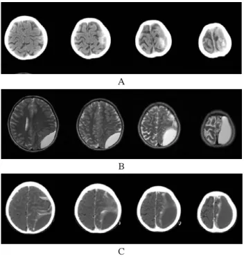 Fig. 3. Gross feature of the specimen obtained from the epidural surface. The specimen appeared to be composed of old blood clots with a membranous surface.