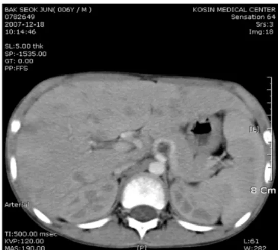 Fig. 1. USG finding showed multiple variable sized hyperechoic nodules in both hepatic lobes.