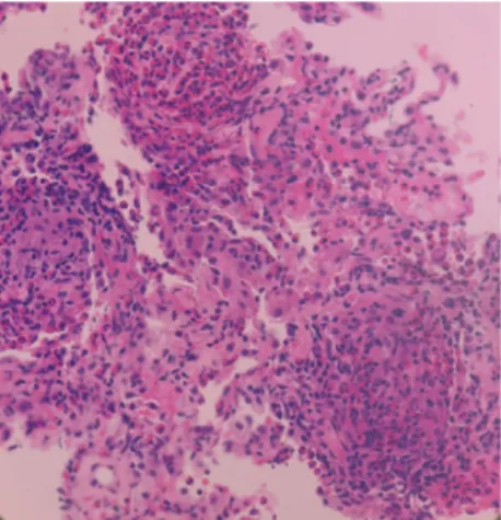 Fig 3. Histologic finding shows organizing pneumonia pattern with severe infiltration of eosinophils