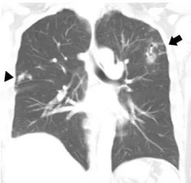 Fig 4. The coronary section of chest CT shows newly developed S shaped tunnel formation (arrow) at the left upper lobe, several nodules (arrow head) in both lung and elevated right diaphragm with small pleural effusion.