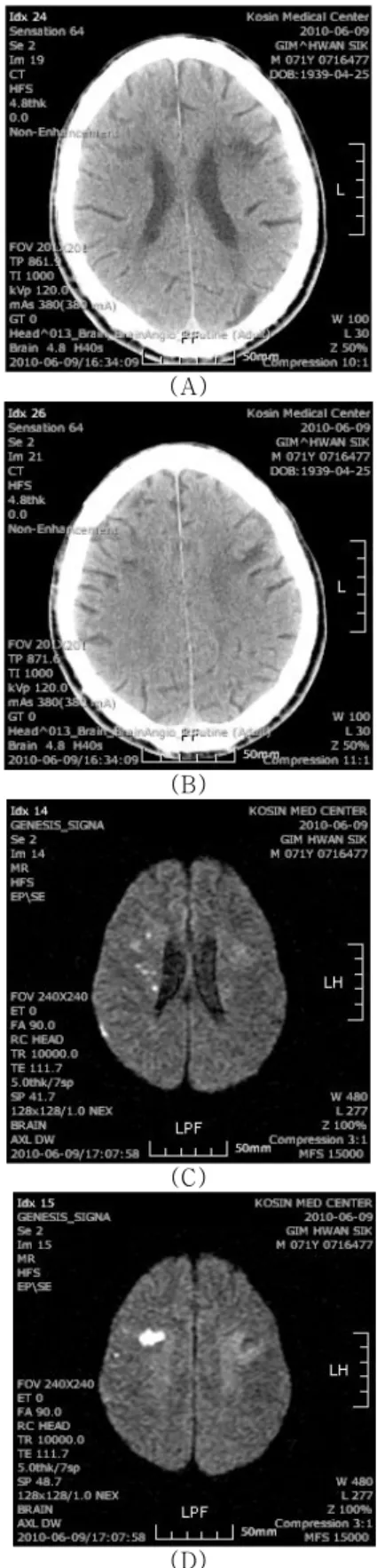 Fig. 1. Brain CT and MRI of a patient. Brain CT shows (D) suspicious low density lesions in the right anterior centrum semiovale region and focal encephalomalacia in the left frontal lobe (A, B)