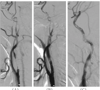 Fig. 2. Cerebral angiography of a patient. Carotid angiography shows severe stenotic narrowing in the bulbar and cavernous portions of the right internal carotid artery (A)