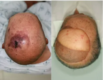 Fig 4. (Left) Preoperative photography, A 74-years old man with angiosarcoma on parietal scalp