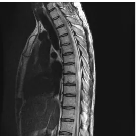 Fig. 1. High signal intensity at thoracic spinal cord. The spinal cord shows diffuse high signal intensity lesion from the level of T2 to T12