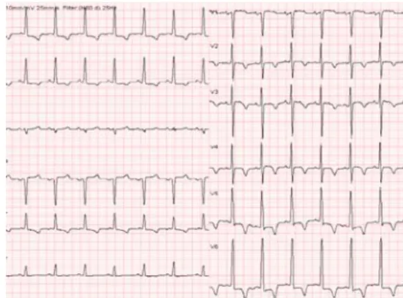 Fig. 2. The ECG on admission shows giant T wave inversion in precordial leads.