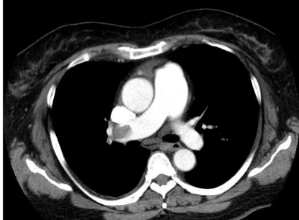 Fig 4. Chest CT findings of the patient on admission.