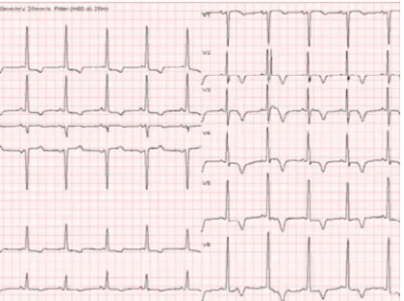 Fig 3. On hospital day 2weeks, the ECG shows no significant interval change compared with admission(figure 1)