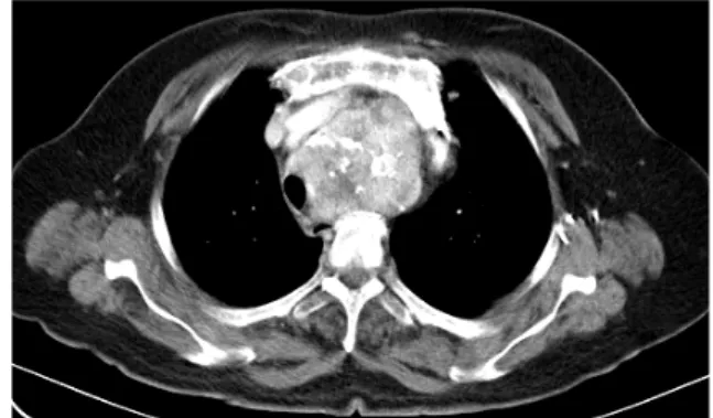Fig. 2. Contrast-enhanced thoracic computed tomography revealed a large mediastinal mass