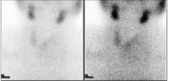 Fig. 5. Histologic finding was thyroid tissue with a benign looking papilla. No evidence of malignancy was found