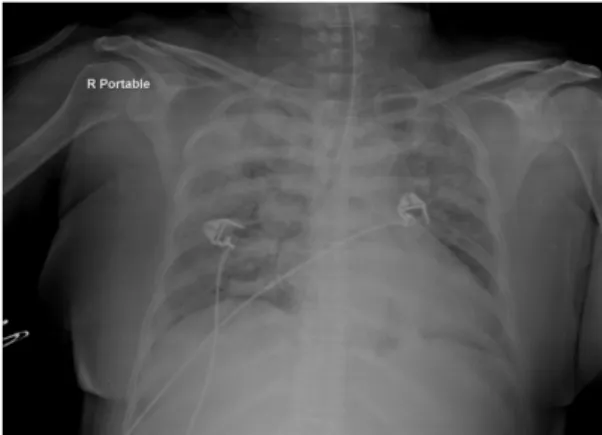 Fig 1. Chest X-ray shows diffuse interstitial infiltration on both lung fields.