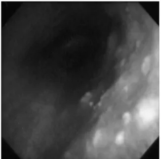 Fig. 1. Chest Computued tomography finding. Chest CT  showed thickening of tracheal and bronchial wall, multiple 