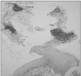 Fig. 4. Biopsy findings. Biopsy specimen showed nonspecific  bronchitis with squamous metaplasia and metaplastic  ossification (H&amp;E stain X 400).