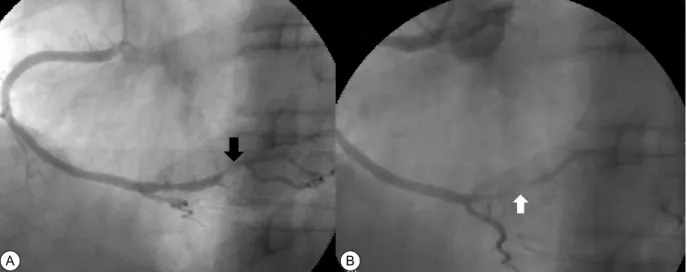 Fig. 1. Serial changes of  right coronay artery during diagnostic coronary angiogram (CAG)