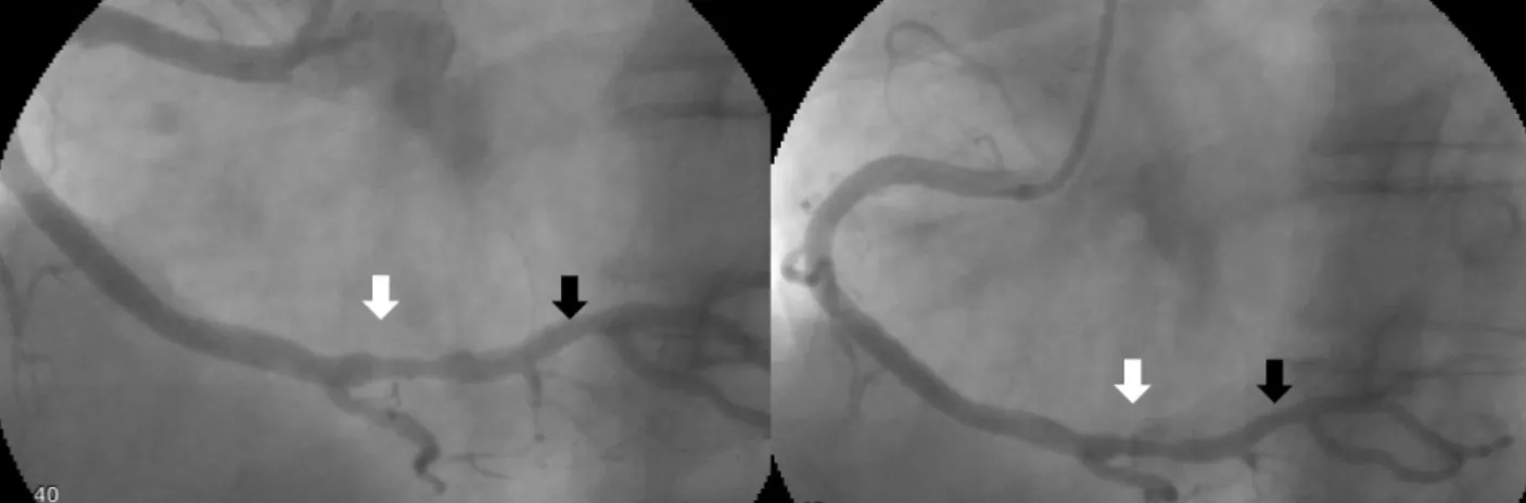Fig. 2. Right coronary artery migrating spasm was resolved after intracoronay injection of nitroglycerin