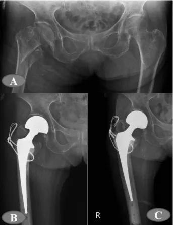 Fig. 1. (A) Pelvic radiograph showed the unstable inter- inter-trochanteric fracture of right femur