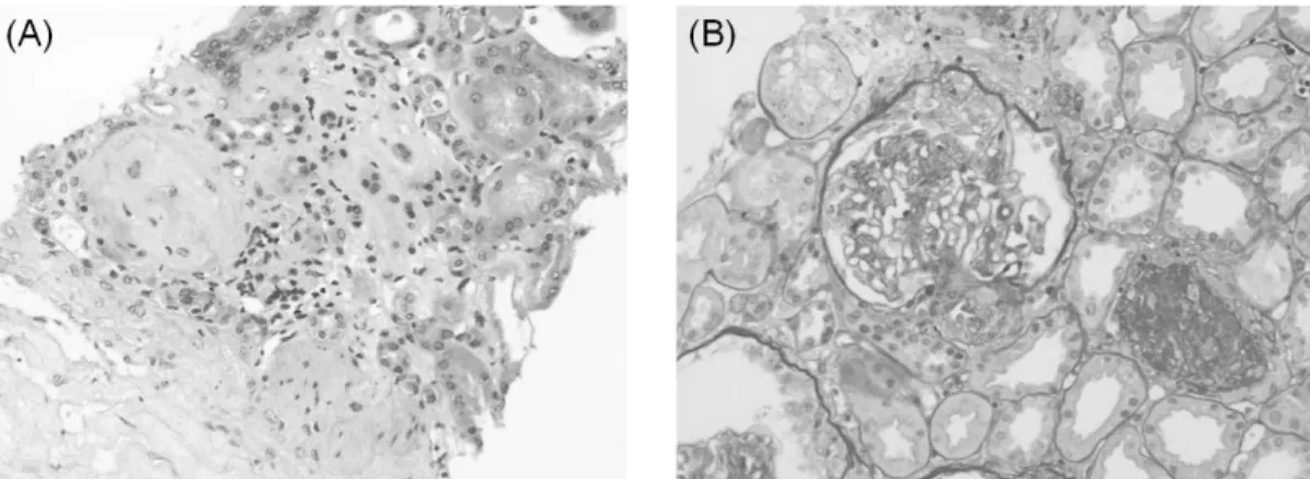 Fig. 4. light microscopic finding of renal biopsy. (A) glomeruli show global sclerosis
