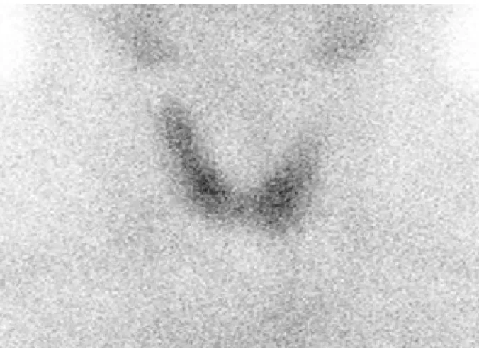 Fig. 3. Tc-99m thyroid scan revealed decrease uptake of  tracers.