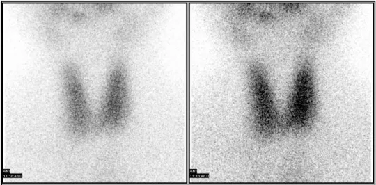 Fig. 1. Thyroid scan showed diffuse uptake of radio iodine.