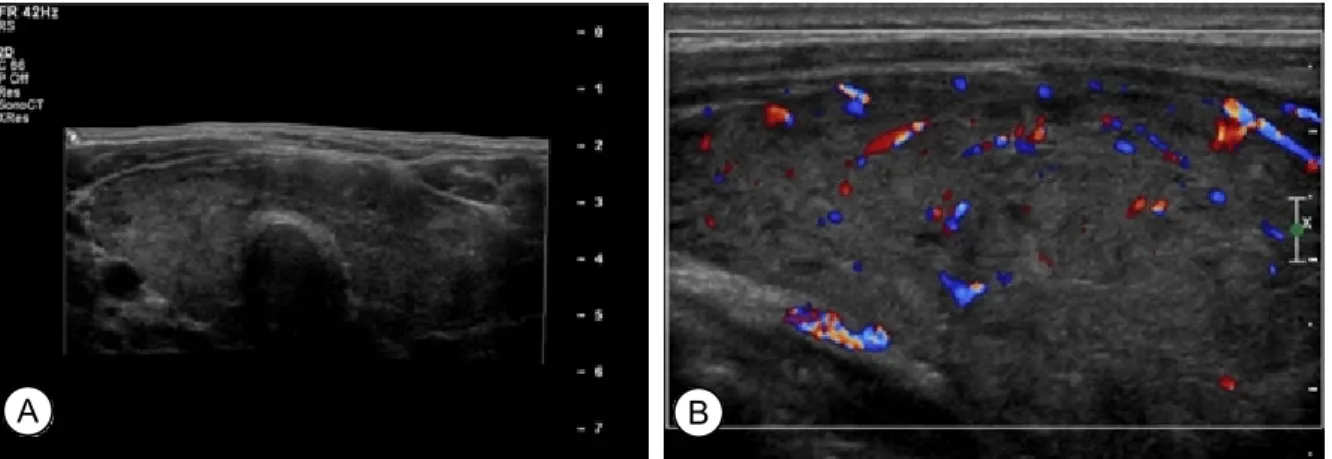 Fig. 4. Ultrasonography of the thyroid. (A) Sonogram showed diffuse enlarged thyroid gland with heterogenous echogenecity  (0.92 cm of isthmus, 2.7 cm of right lobe, 2.36 cm of left lobe), (B) Sonogram presented thyroid gland with hypervascularity.
