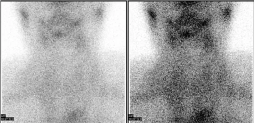 Fig. 5.  Non-visualization of both thyroid lobes (I-131 uptake = 1%). 기능항진증에서 방사성 동위원소의 섭취율이 감소한 것 은 갑상선스캔 검사를 하기 6일 전 시행한 흉부 전산화단 층촬영 검사에 사용된 조영제(radiocontrast dye)에 의한  것으로  생각된다